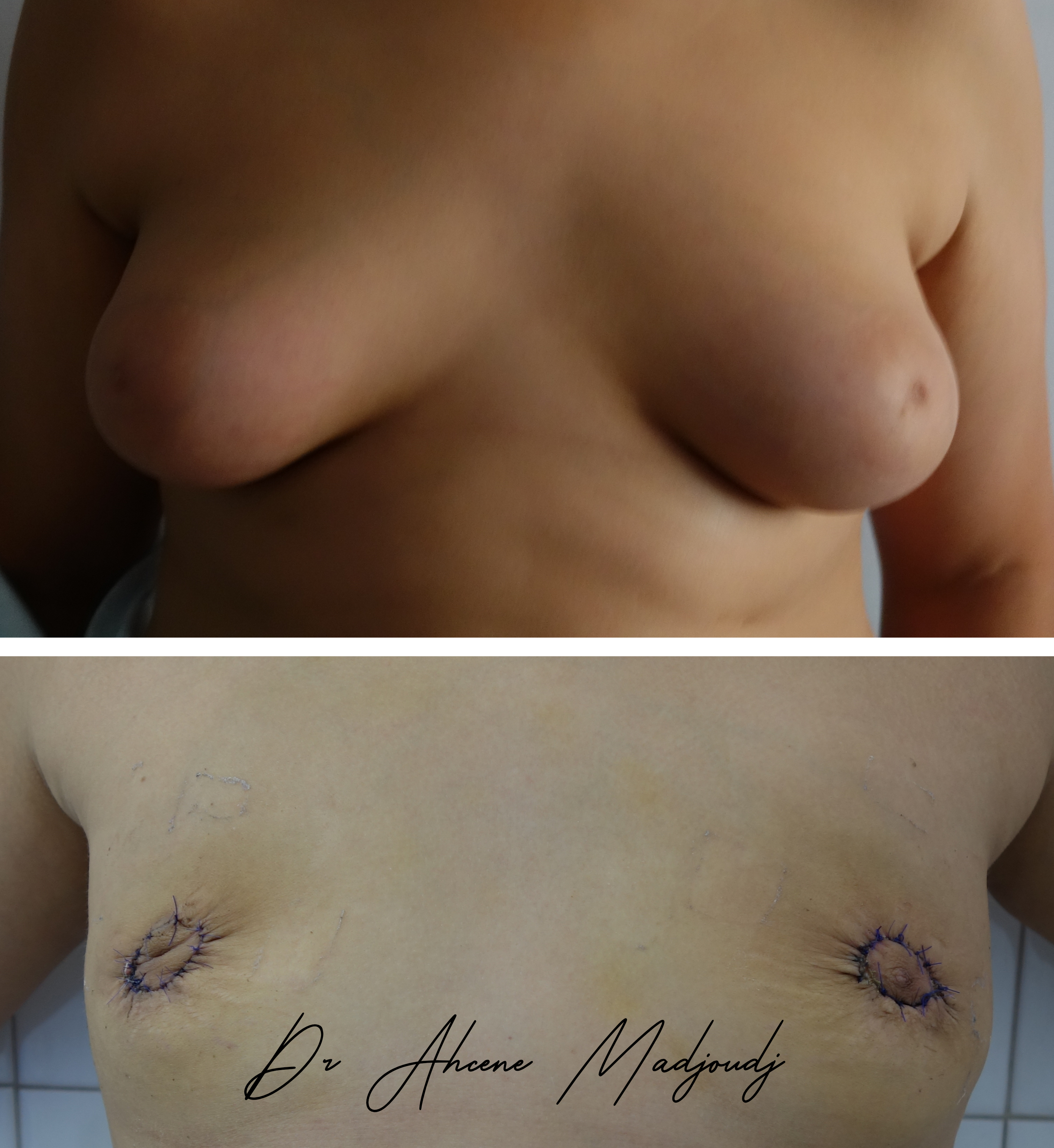 Gynécomastie ou chirurgie des seins chez l'homme en Algérie