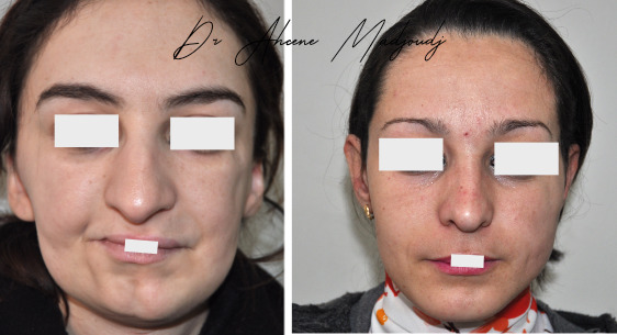 Lipofilling en Algerie ou le remplissage par la graisse 